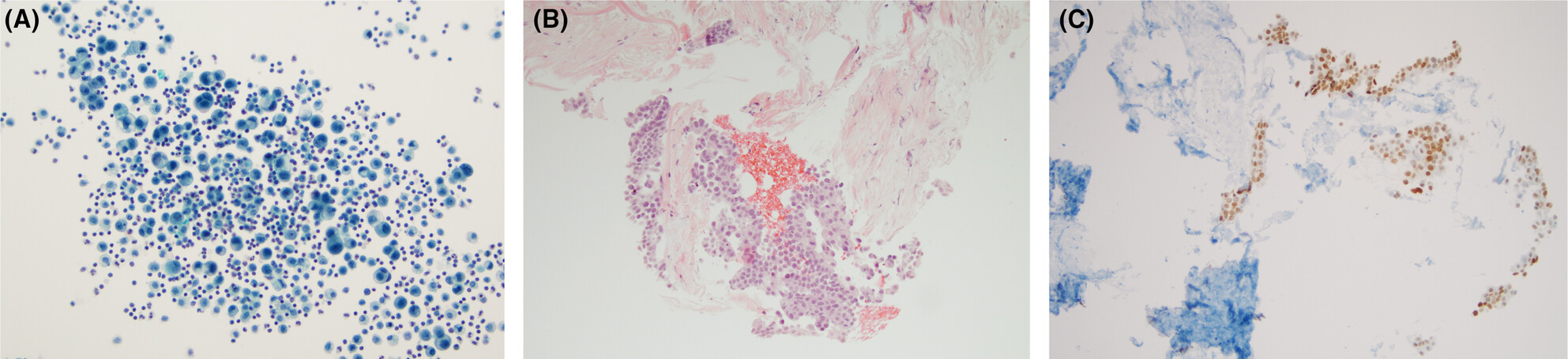 Application of the international system for reporting serous fluid cytopathology on pleural effusion cytology with paired pleural biopsy: A new insight and novel approach on risk of malignancy