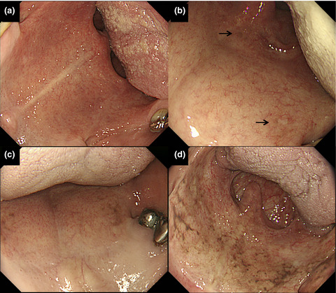 Soft palatal melanosis, a simple predictor for neoplasia in the upper aerodigestive tract in Japanese alcoholic men