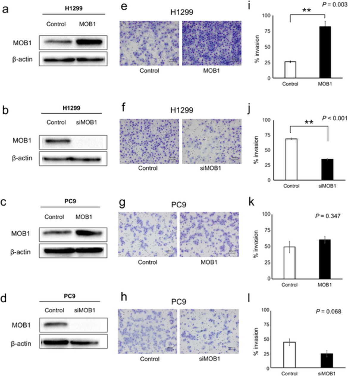 Association of Mps one binder kinase activator 1 (MOB1) expression with poor disease-free survival in individuals with non-small cell lung cancer