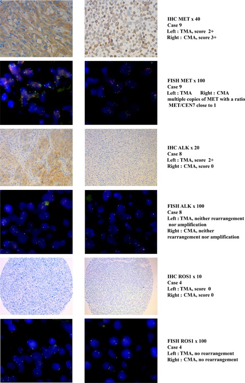Crizotinib targets in glioblastoma stem cells