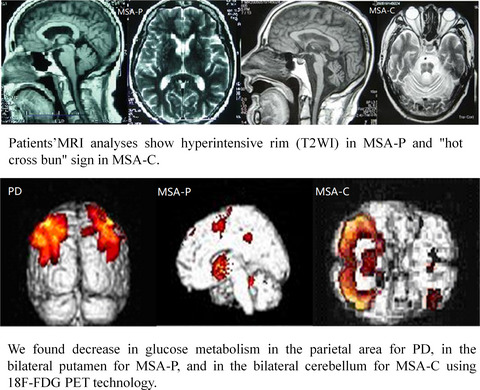 Clinical features, MRI, and 18F-FDG-PET in differential diagnosis of Parkinson disease from multiple system atrophy