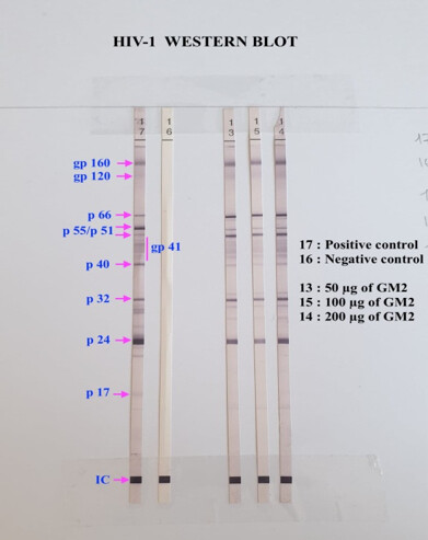 Anti-GM2 antibodies-associated meningoradiculitis in the context of HIV immune reconstitution inflammatory syndrome