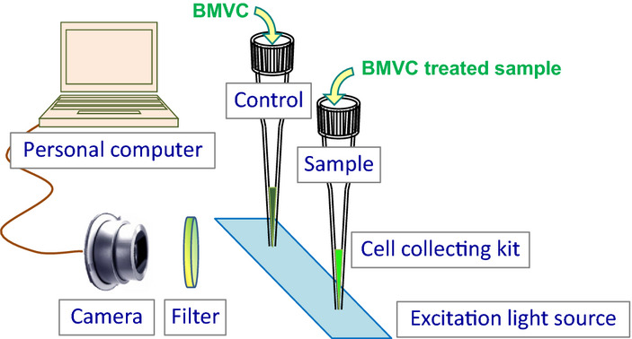 BMVC test, an improved fluorescence assay for detection of malignant pleural effusions
