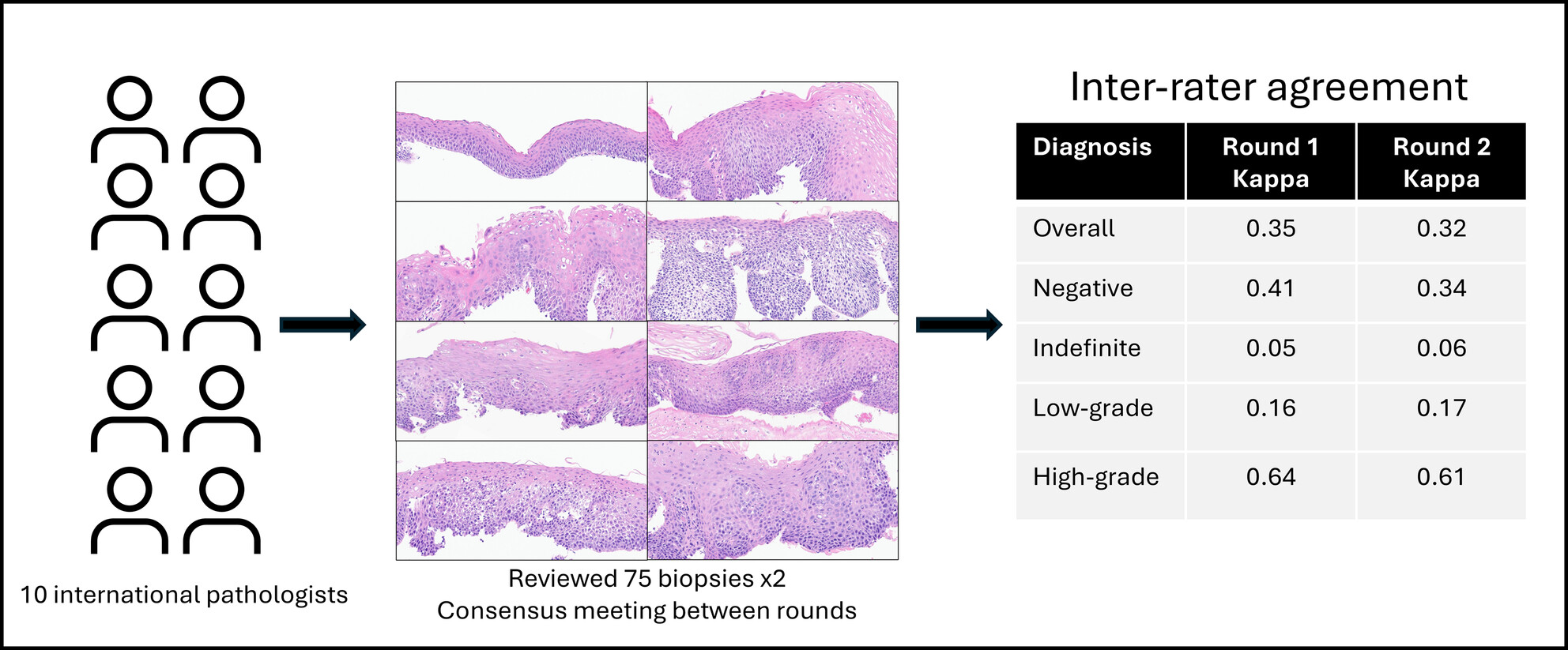 An international inter-rater agreement study in the challenging diagnosis of squamous dysplasia of the oesophagus