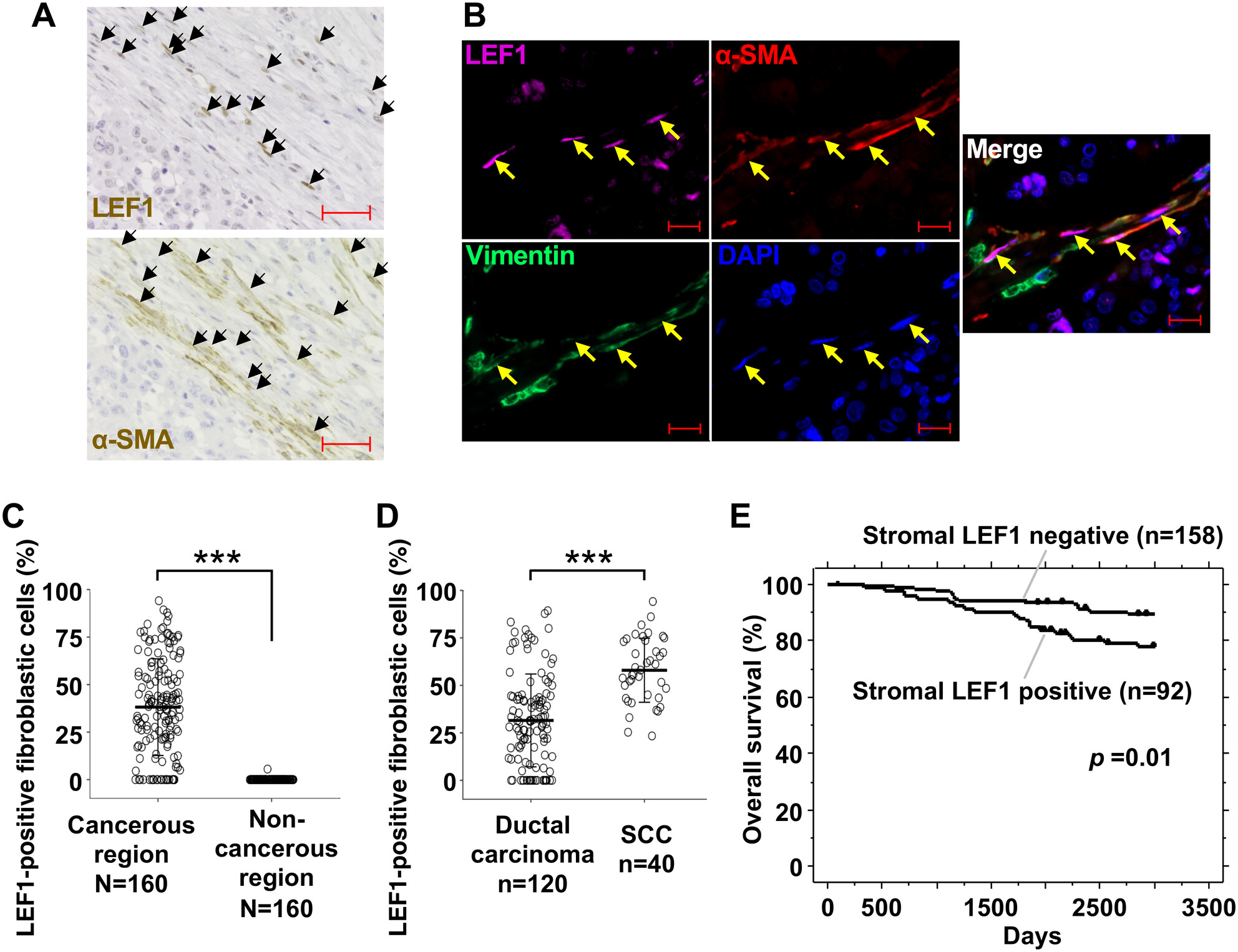 Expression of Lymphoid Enhancer-Binding Factor 1 in Cancer-Associated Fibroblasts Mediates Tumor Growth and Transdifferentiation Toward Squamous Cell Carcinoma in Human Breast Cancer