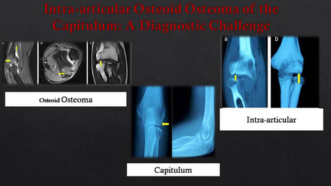 Intra-articular osteoid osteoma of the capitulum: A diagnostic challenge