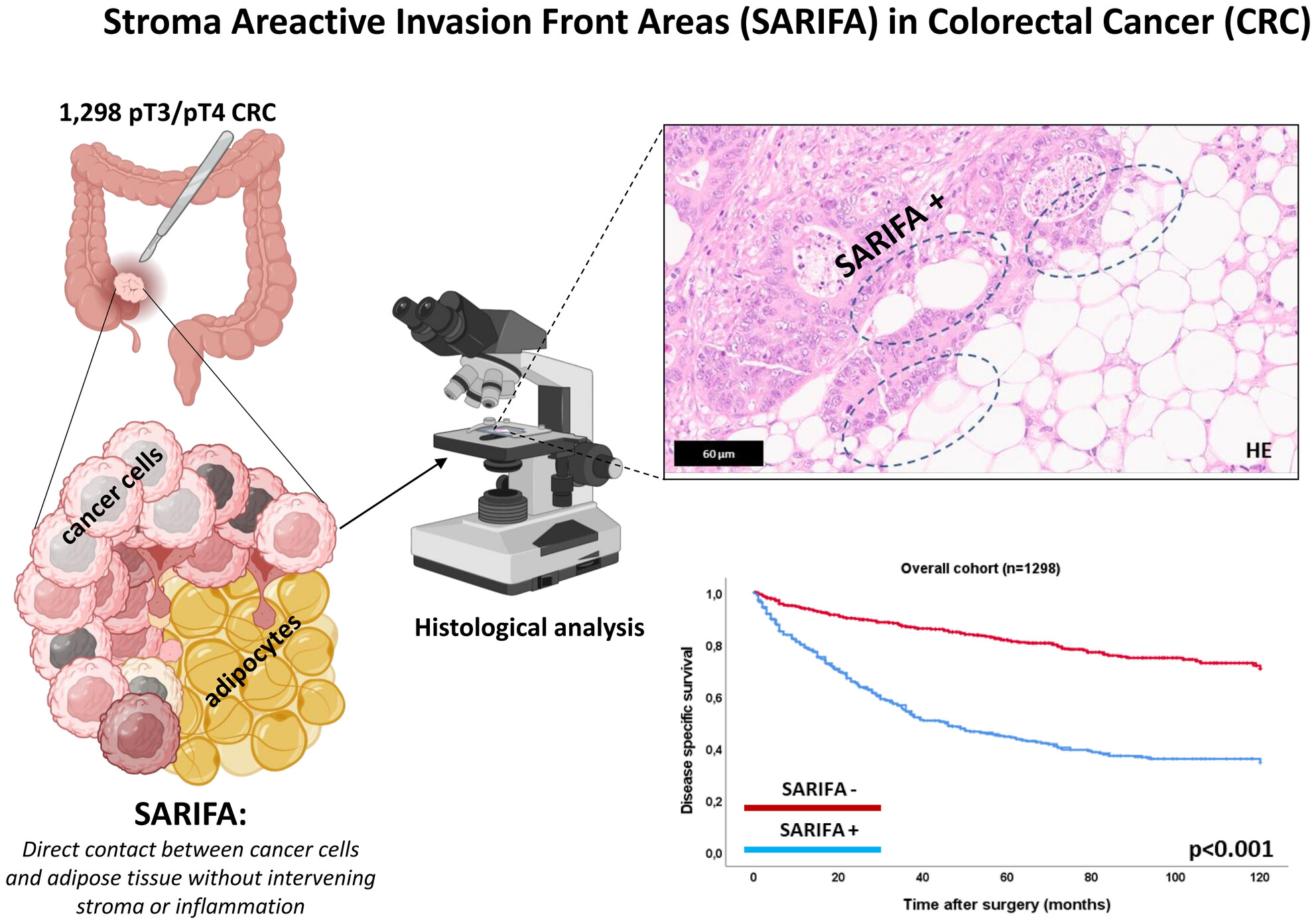 Stroma areactive invasion front areas (SARIFA) in 1,298 pT3/pT4 colorectal cancers: A strong prognostic parameter complementing established morphological criteria