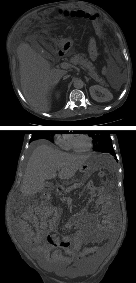 Nontuberculous mycobacterial infection in a patient with myelofibrosis: case report and concise review