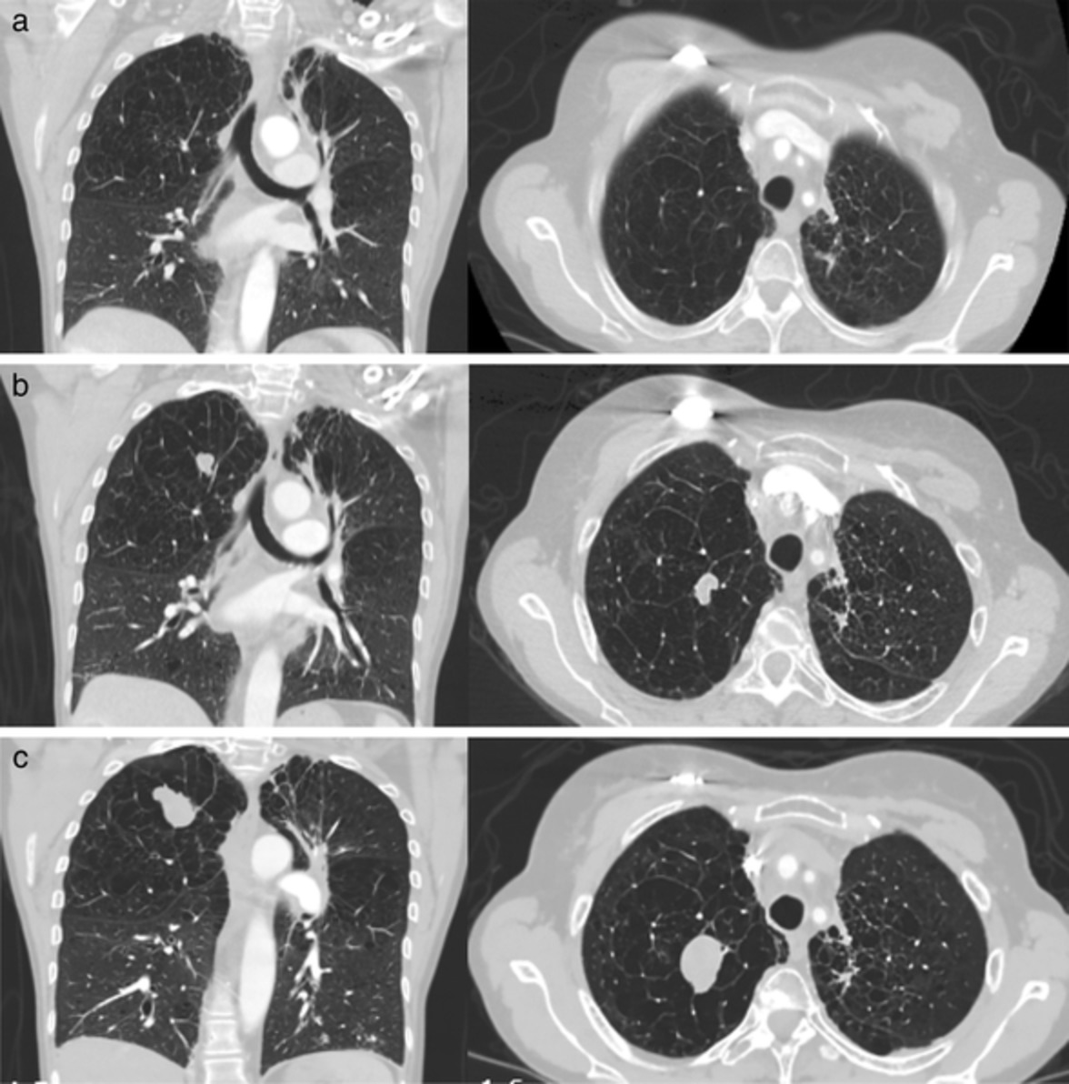 Incidental early diagnosis of biphasic pulmonary blastoma in a patient with history of stage IV lung adenocarcinoma