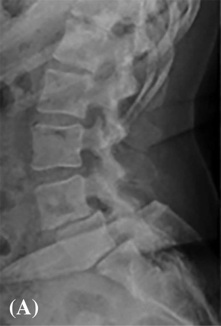 Gut microbiome dysbiosis is associated with lumbar degenerative spondylolisthesis in symptomatic patients