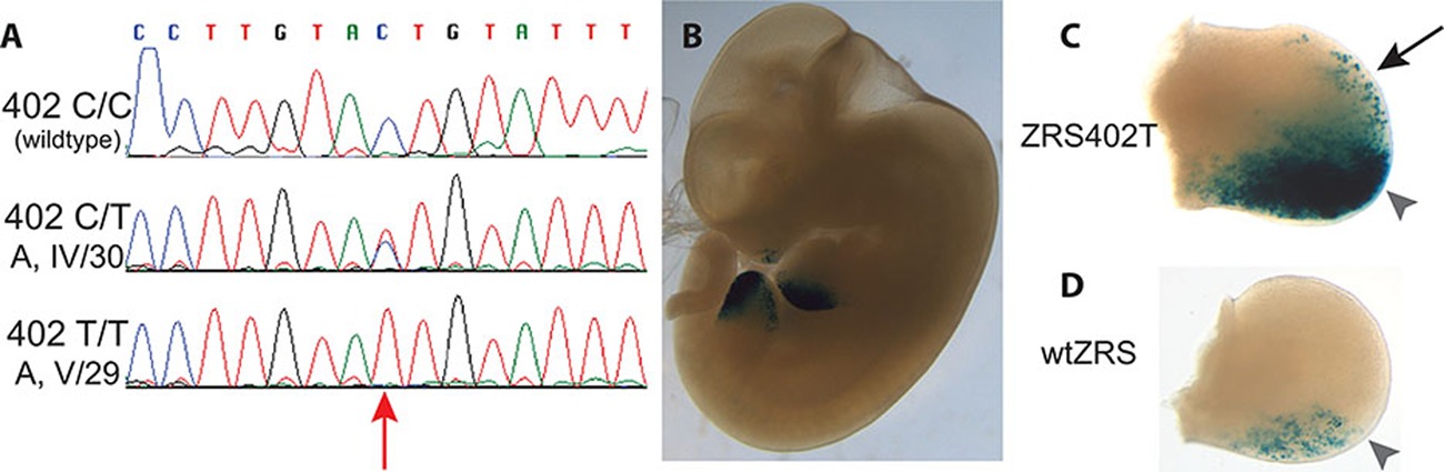 A Novel ZRS Mutation Leads to Preaxial Polydactyly Type 2 in a Heterozygous Form and Werner Mesomelic Syndrome in a Homozygous Form