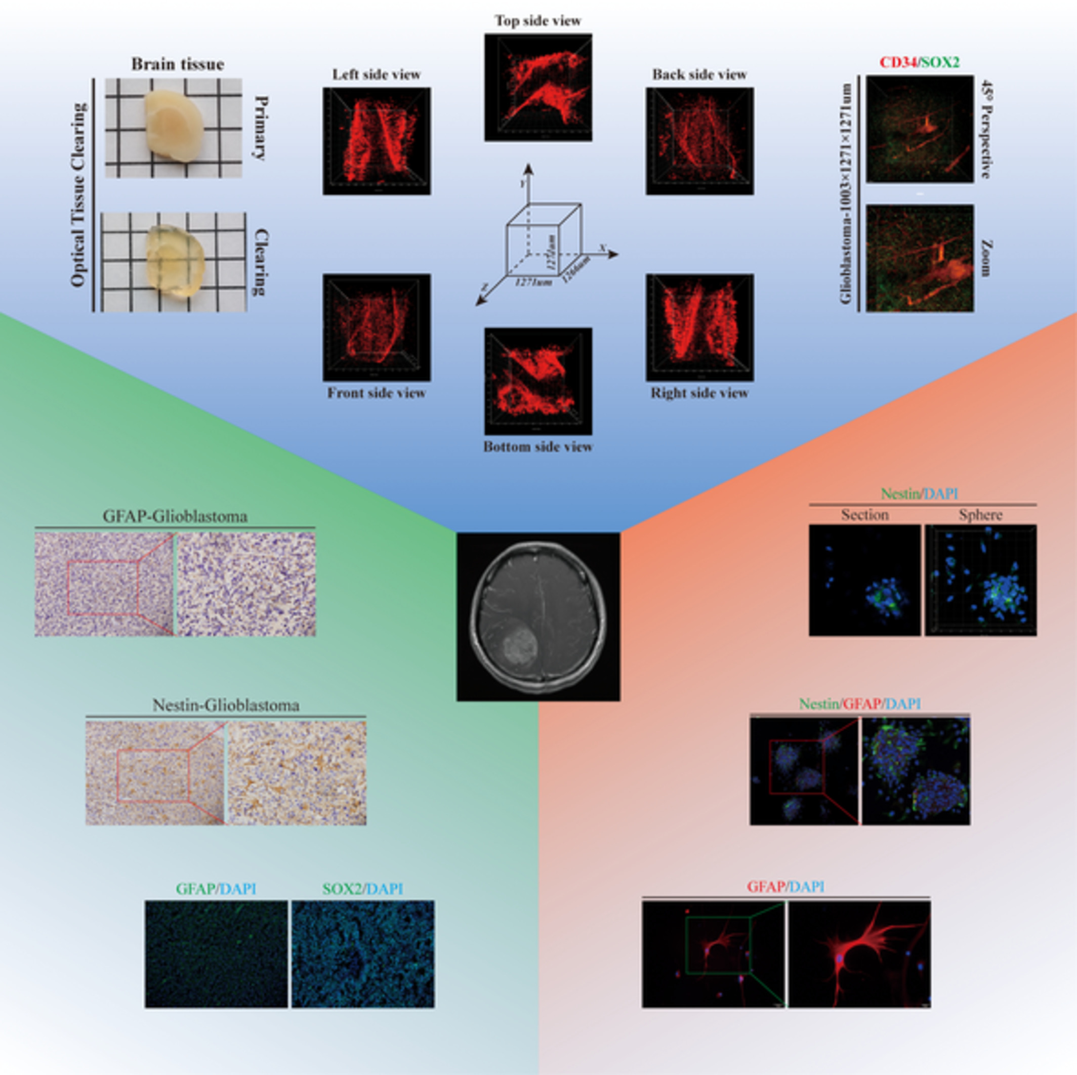 The combination of two-dimensional and three-dimensional analysis methods contributes to the understanding of glioblastoma spatial heterogeneity