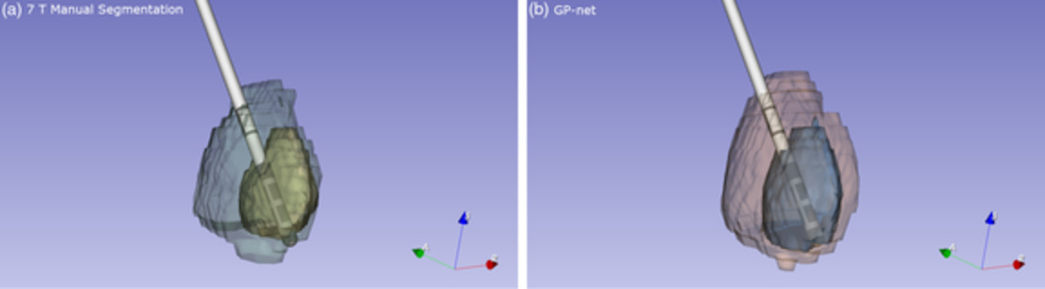 Deep-learning based fully automatic segmentation of the globus pallidus interna and externa using ultra-high 7 Tesla MRI