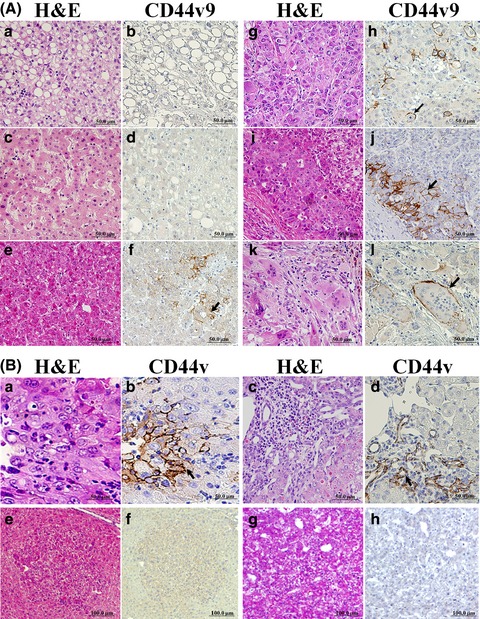 CD44 variant 9 is a potential biomarker of tumor initiating cells predicting survival outcome in hepatitis C virus-positive patients with resected hepatocellular carcinoma