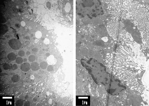 Renal Fanconi syndrome with ultrastructural defects in lysinuric protein intolerance