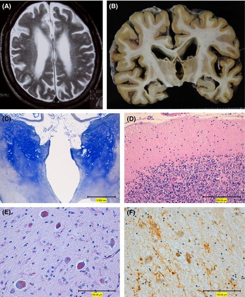 The first genetically confirmed Japanese patient with mucolipidosis type IV
