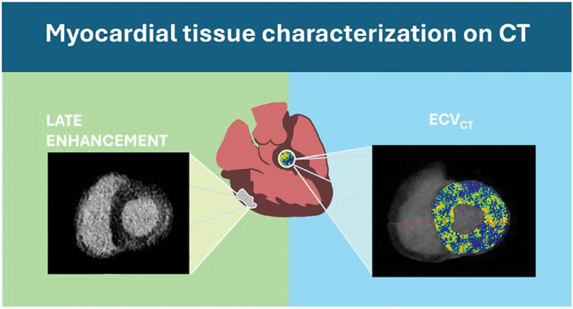 Myocardial Characterization on CT: Late Iodine Enhancement and Extracellular Volume