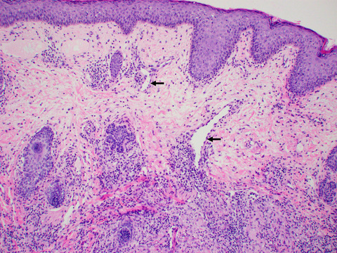 A case of pediatric rosacea—Skin and ocular involvement