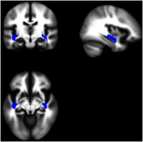 Cardiovascular risk factors and APOE-ε4 status affect memory functioning in aging via changes to temporal stem diffusion