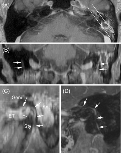 Enhanced fallopian canal as a potential marker for temporal bone vasculitis