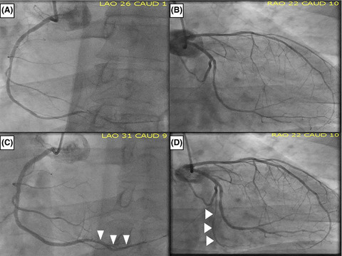 First case report: Late-onset coronary artery spasm after radiofrequency catheter ablation for atrial fibrillation in a Caucasian patient