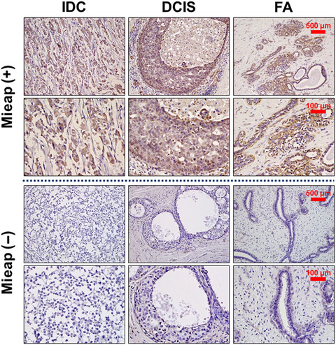Possible role of p53/Mieap-regulated mitochondrial quality control as a tumor suppressor in human breast cancer