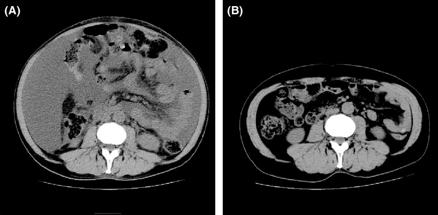 Thalidomide for tocilizumab-resistant ascites with TAFRO syndrome
