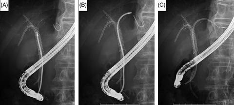 The placement of multiple plastic stents still has important roles in candidates for chemotherapy for unresectable perihilar cholangiocarcinoma