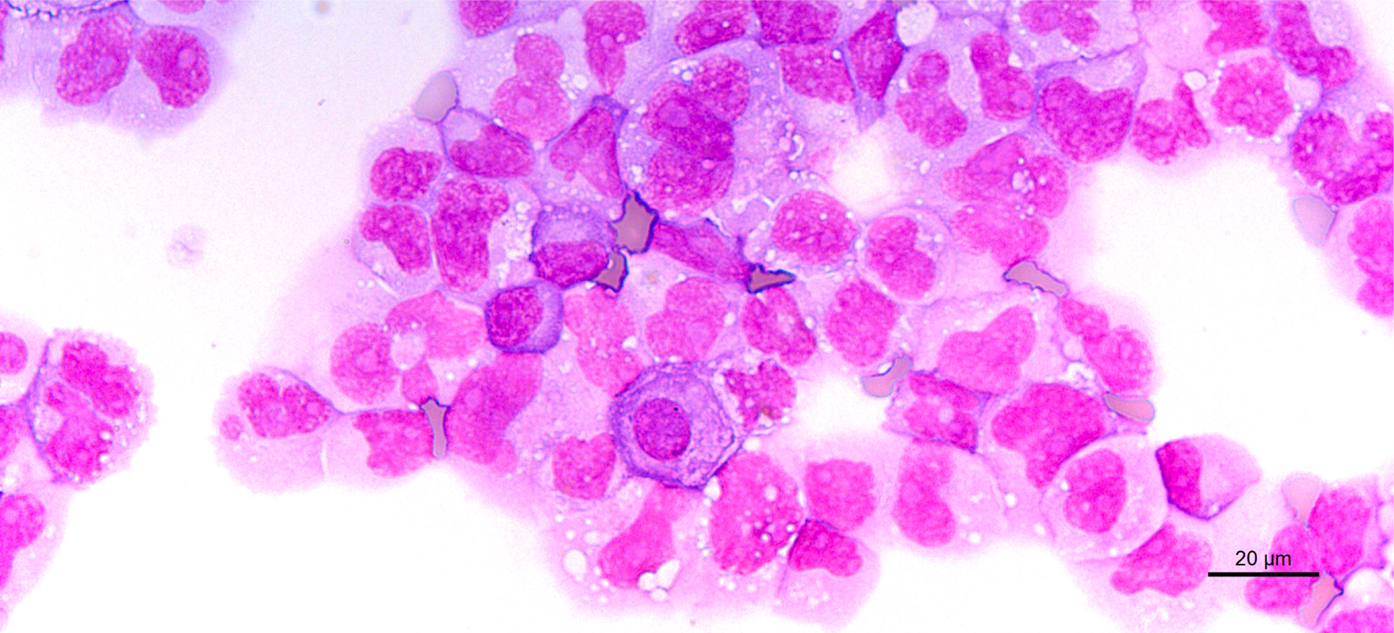 Quiz case: Abnormal haematopoietic cells in pleural effusion