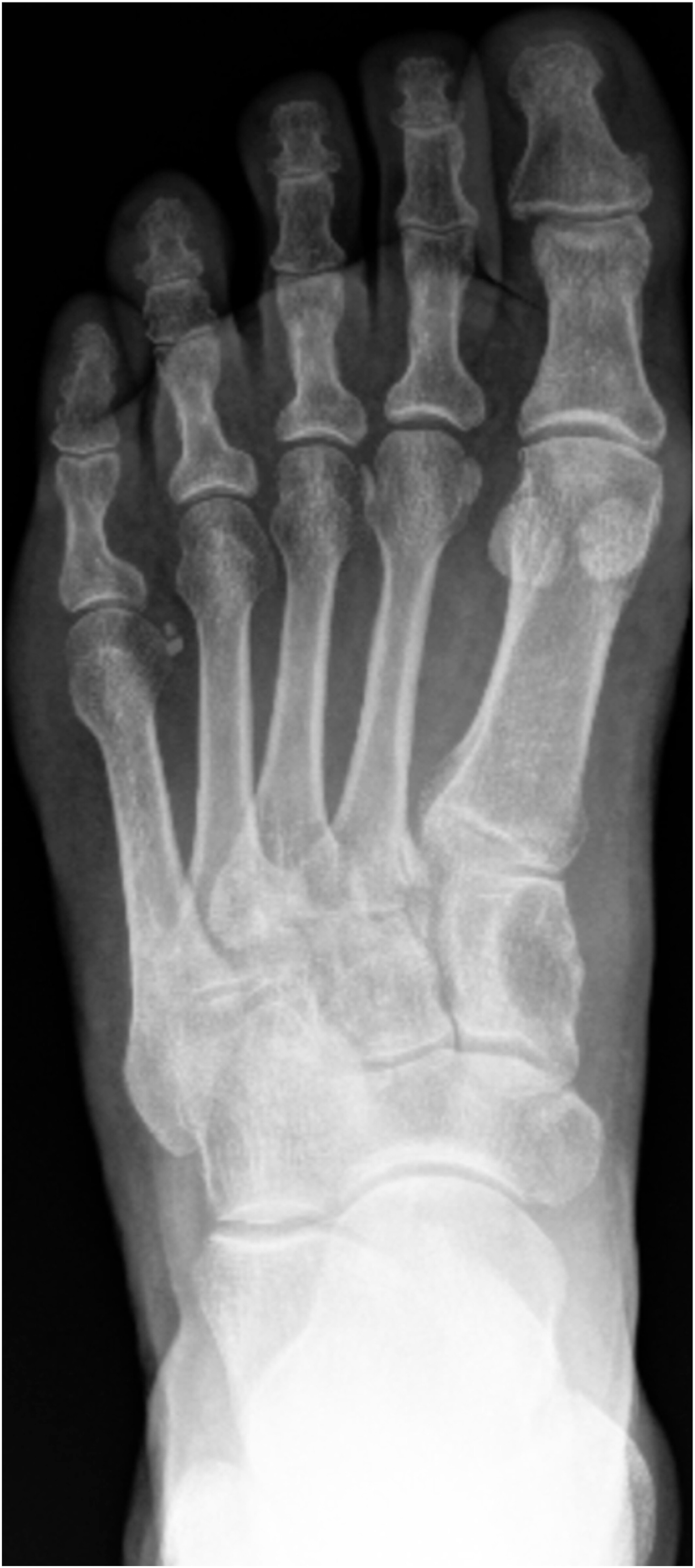 Foot pain as first presenting symptom of renal cell carcinoma, due to metastatic lesion in medial cuneiform