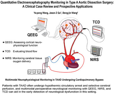 Quantitative Electroencephalography Monitoring in Type A Aortic Dissection Surgery: A Clinical Case Review and Prospective Applications