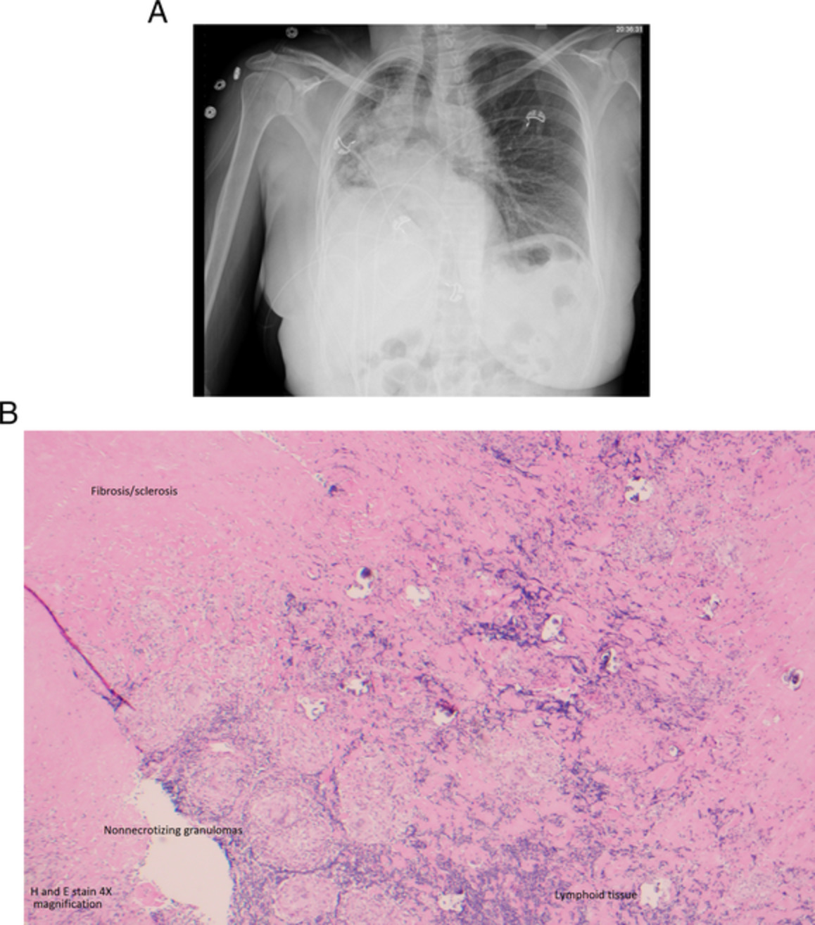 Complete lung collapse as a rare complication of sarcoidosis-associated mediastinal lymphadenopathy