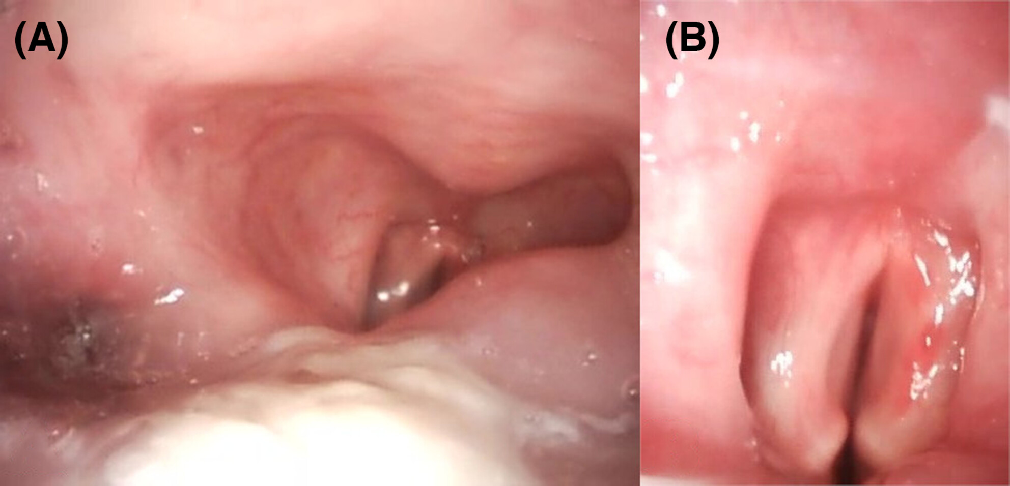 Bilateral vocal cord palsy induced by long-term use of small-bore nasogastric tube