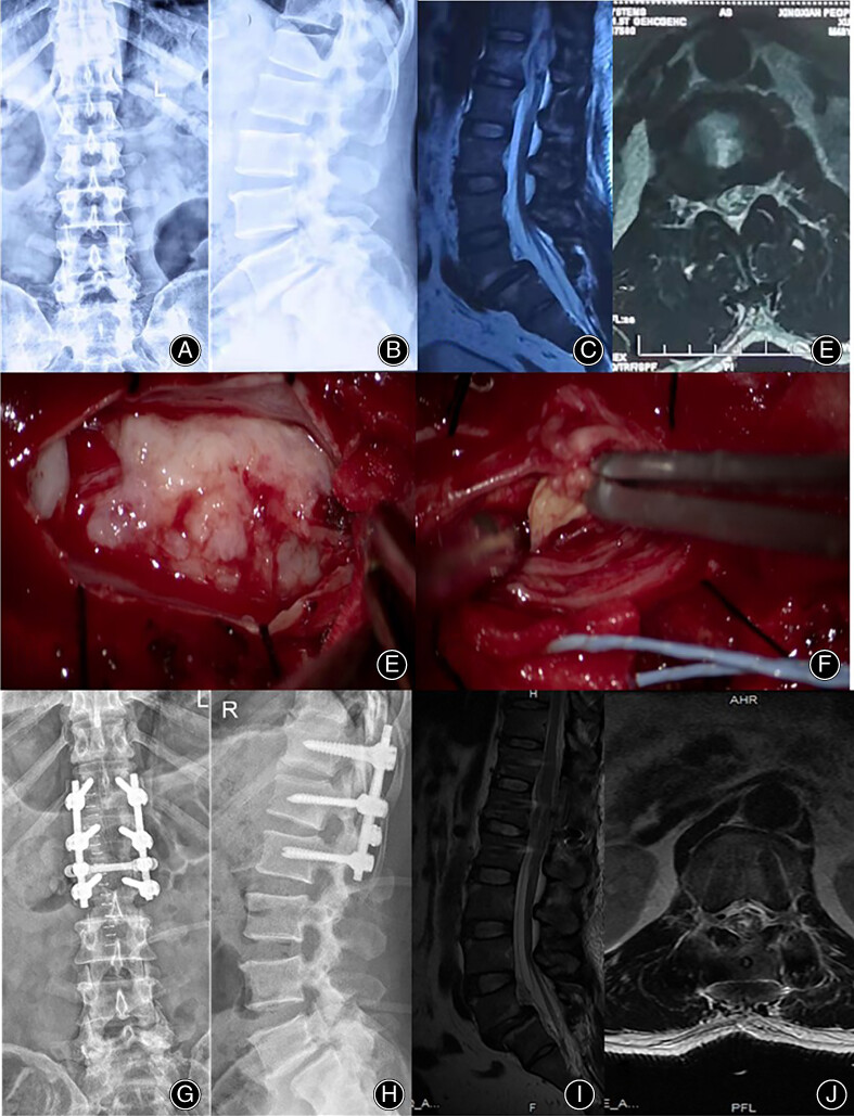 Lumbar Intradural Disc Herniation Caused by Injury: A Case Report and Literature Review