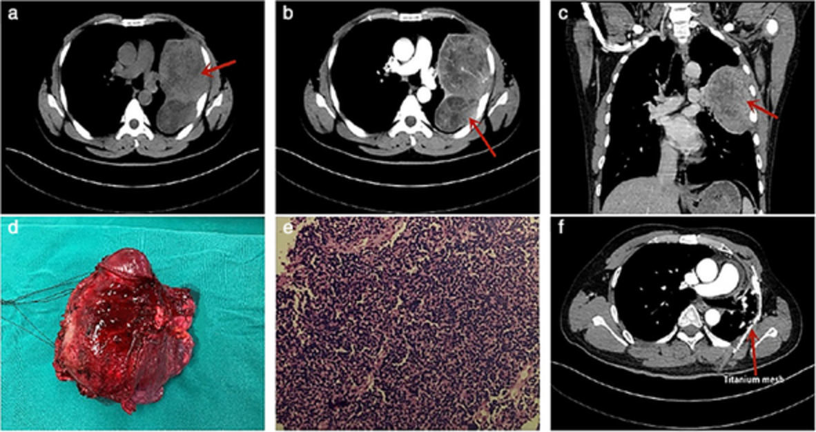 Askin tumor in the chest wall