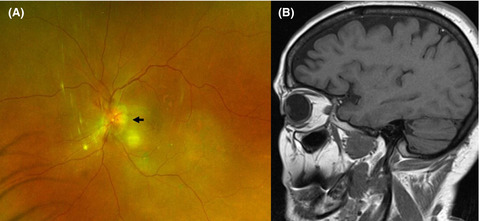 An uncommon cause of loss of vision in a dialysis patient with lupus
