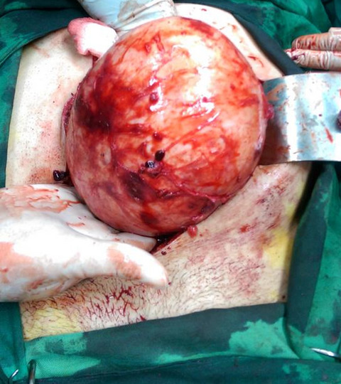 Pelvic Schwannoma: In light of a case report