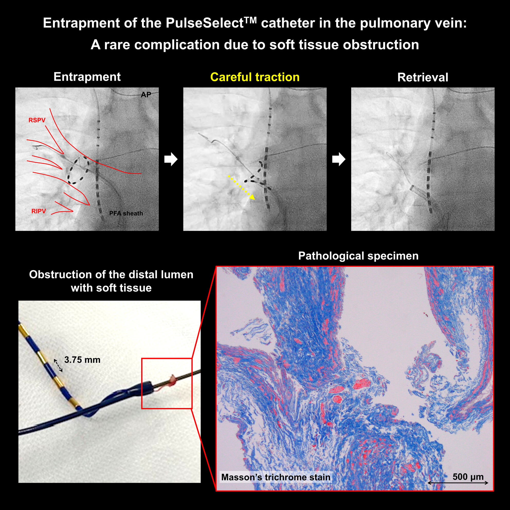 Entrapment of the PulseSelect™ catheter in the pulmonary vein: A rare complication due to soft tissue obstruction