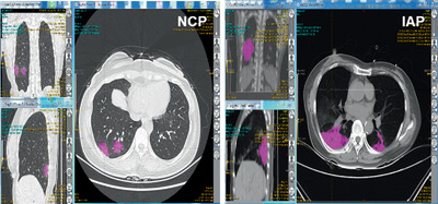 Radiomics-based model for accurately distinguishing between severe acute respiratory syndrome associated coronavirus 2 (SARS-CoV-2) and influenza A infected pneumonia