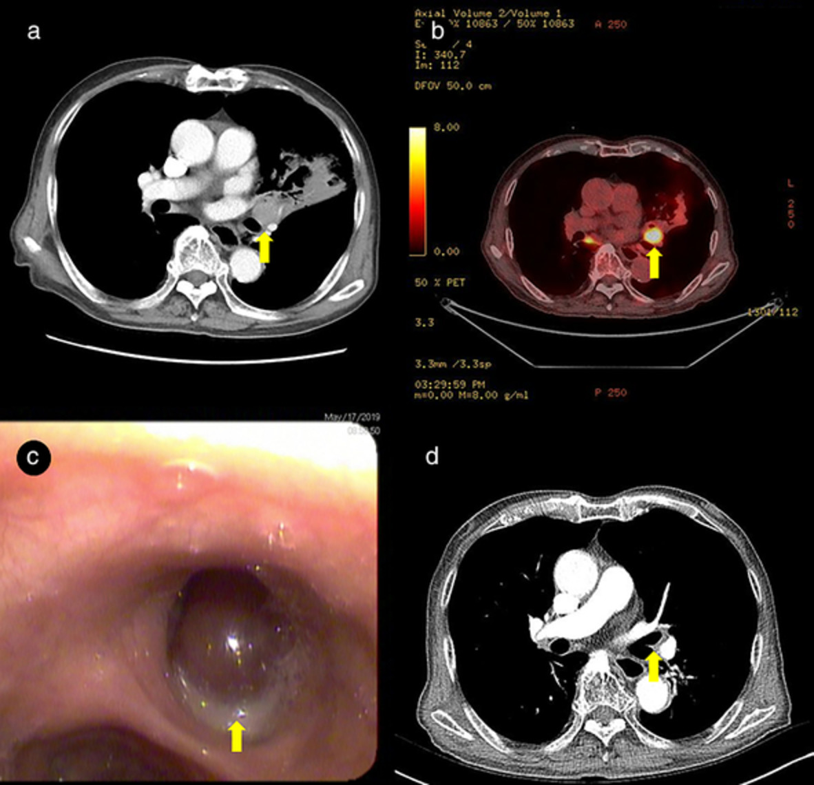 A rare case of primary solitary endobronchial plasmacytoma