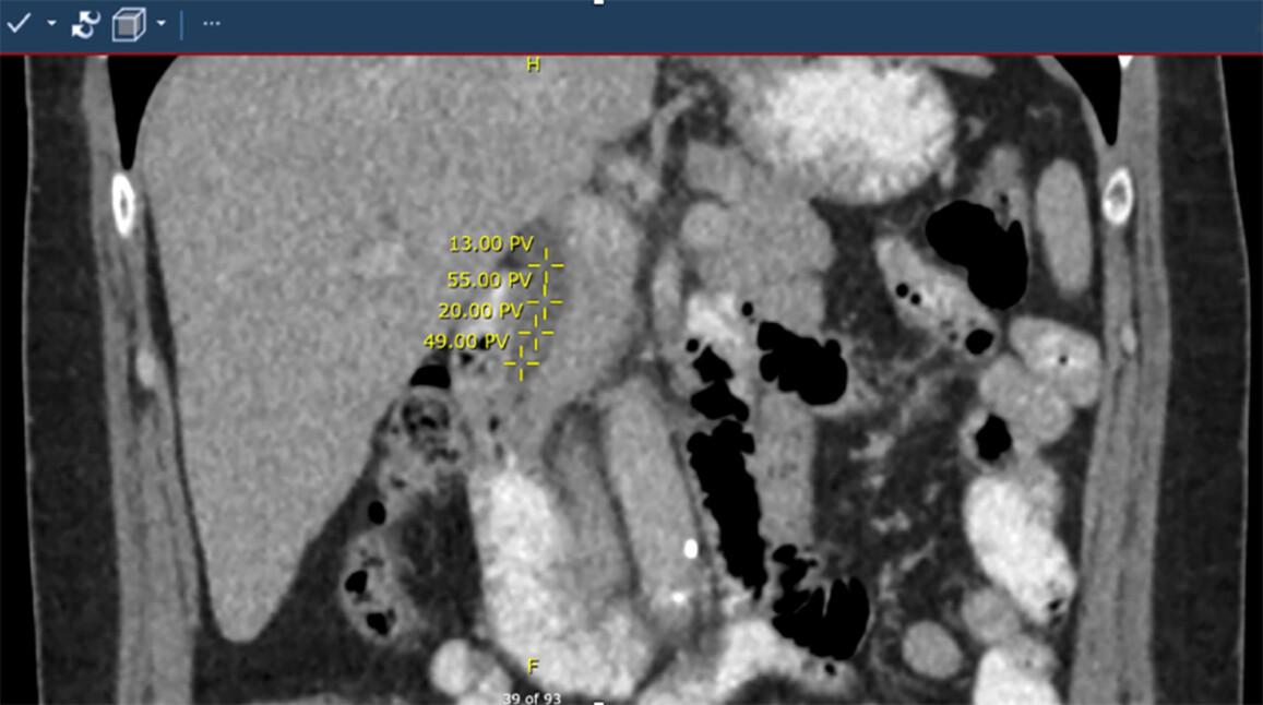 Measurement of the distal bile duct density on computed tomography can differentiate choledocholithiasis from a control population