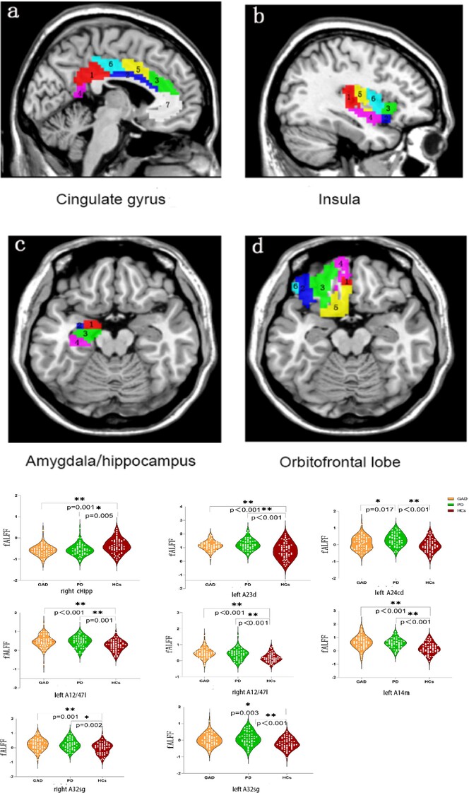 Abnormal regional activity in the prefrontal-limbic circuit at rest: Potential imaging markers and treatment predictors in drug-naive anxiety disorders
