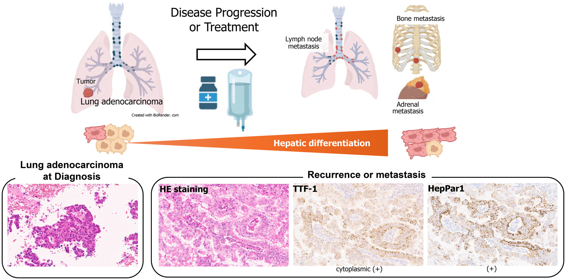 Dynamic nature of hepatic differentiation in lung adenocarcinoma