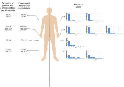 Increased muscle echointensity correlates with clinical disability and muscle strength in chronic inflammatory demyelinating polyneuropathy