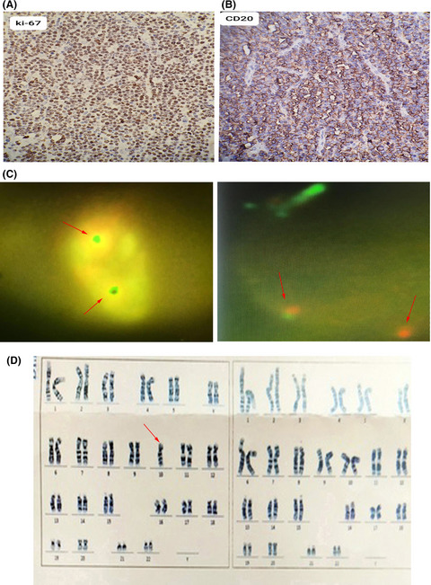 Primary bilateral ovarian involvement in Burkitt's lymphoma with an adnexal Torsion-like manifestation: A case report