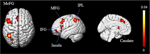 Deductive-reasoning brain networks: A coordinate-based meta-analysis of the neural signatures in deductive reasoning