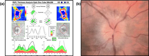 Practical recognition tools of immunoglobulin G serum antibodies against the myelin oligodendrocyte glycoprotein-positive optic neuritis and its clinical implications