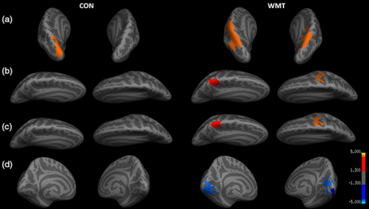 Cortical and subcortical responsiveness to intensive adaptive working memory training: An MRI surface-based analysis