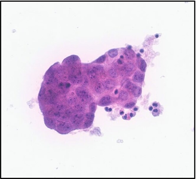 Higher sensitivity of pericardial fluid cytology than biopsy in malignant effusions with potential explanation of false-negative cytology: A multi-institutional analysis