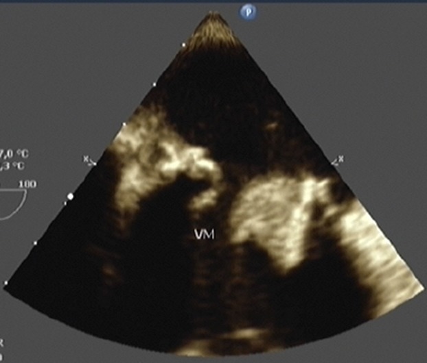 Cardiogenic shock due to Gemella morbillorum native mitral valve endocarditis